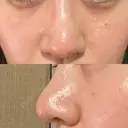 鼻尖形成（切開） / 鼻尖縮小 / その他（鼻） 聖心美容クリニック 札幌院 DAY 12 サムネイル用