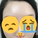 脂肪注入（額） 牧野美容クリニック AFTER サムネイル用