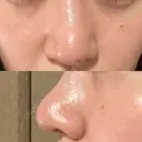 鼻尖形成（切開） / 鼻尖縮小 / その他（鼻） 聖心美容クリニック 札幌院 DAY 13 サムネイル用