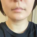 脂肪吸引（顔） THE CLINIC（ザ・クリニック） 福岡院 DAY 14 サムネイル用