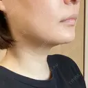 脂肪吸引（顔） THE CLINIC（ザ・クリニック） 福岡院 DAY 14 サムネイル用