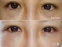 下まぶたたるみ取り / ヒアルロン酸注入（唇） / ヒアルロン酸注入（目の下） MIL CLINIC OSAKA DAY 6 サムネイル用