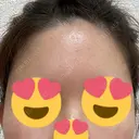 脂肪注入（額） / 脂肪注入（輪郭） 牧野美容クリニック DAY 12 サムネイル用