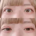 二重切開 松下皮フ形成外科 DAY 20 サムネイル用