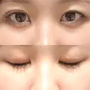 目頭切開 目白ポセンシアクリニック AFTER サムネイル用