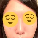 隆鼻術 / 鼻尖縮小 / ヒアルロン酸注入（鼻） 品川美容外科 福岡院 AFTER サムネイル用