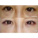 下まぶたたるみ取り / ヒアルロン酸注入（唇） / ヒアルロン酸注入（目の下） MIL CLINIC OSAKA DAY 7 サムネイル用