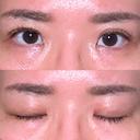 二重埋没 東京ベレッザクリニック DAY 99 サムネイル用