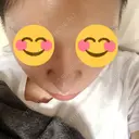 隆鼻術 / 鼻尖形成（切開） / 鼻中隔延長（切開） / 骨切幅寄せ 表参道スキンクリニック 表参道院 DAY 223 サムネイル用