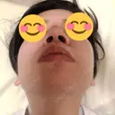 隆鼻術 / 鼻尖形成（切開） / 鼻中隔延長（切開） / 骨切幅寄せ 表参道スキンクリニック 表参道院 DAY 223 サムネイル用