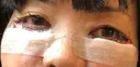 下まぶたたるみ取り / 下まぶたの脂肪取り / 美容点滴・美容注射（美肌） / 白玉点滴・注射 キップン整形外科 DAY 0 サムネイル用