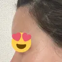 脂肪注入（額） / 脂肪注入（輪郭） 牧野美容クリニック DAY 13 サムネイル用