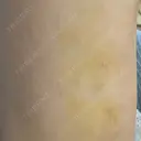 脂肪注入（額） / 脂肪注入（輪郭） 牧野美容クリニック DAY 13 サムネイル用