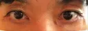 下まぶたたるみ取り / 下まぶたの脂肪取り / 美容点滴・美容注射（美肌） / 白玉点滴・注射 キップン整形外科 AFTER サムネイル用