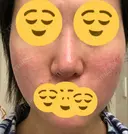 ほくろ・いぼ切除（肌） / その他（肌） / 美肌レーザー / シミ取りレーザー / 美白レーザー クロスクリニック銀座 DAY 42 サムネイル用