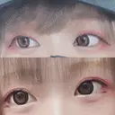 目尻切開 / 目尻靭帯移動 FROM B整形外科 (旧バウム整形外科) AFTER サムネイル用