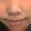 人中短縮 / 口角挙上 / その他（口元） 東京皮膚科・形成外科 (銀座いけだクリニック) DAY 4 サムネイル用