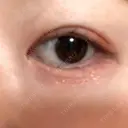 二重埋没 AiZ CLINIC AFTER サムネイル用