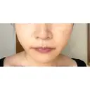 バッカルファット除去 / 脂肪吸引（顔） EMMA CLINIC（エマクリニック） DAY 11 サムネイル用