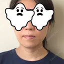 ハイフ（顔） 藤・ナチュレ美容クリニック 恵比寿院 AFTER サムネイル用
