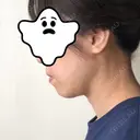 ハイフ（顔） 藤・ナチュレ美容クリニック 恵比寿院 DAY 31 サムネイル用