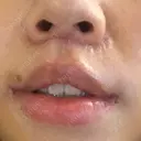 人中短縮 / 口角挙上 / その他（口元） 東京皮膚科・形成外科 (銀座いけだクリニック) DAY 6 サムネイル用