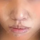 人中短縮 / 口角挙上 / その他（口元） 東京皮膚科・形成外科 (銀座いけだクリニック) DAY 19 サムネイル用