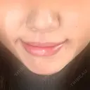 人中短縮 / 口角挙上 / その他（口元） 東京皮膚科・形成外科 (銀座いけだクリニック) DAY 137 サムネイル用