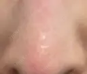 フラクショナルレーザー（毛穴・ニキビ跡） PICO BEAUTY CLINIC AFTER サムネイル用