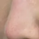フラクショナルレーザー（毛穴・ニキビ跡） PICO BEAUTY CLINIC DAY 23 サムネイル用