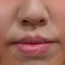 人中短縮 / 口角挙上 / その他（口元） 東京皮膚科・形成外科 (銀座いけだクリニック) AFTER サムネイル用