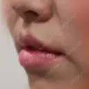 人中短縮 / 口角挙上 / その他（口元） 東京皮膚科・形成外科 (銀座いけだクリニック) DAY 235 サムネイル用