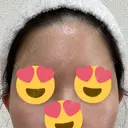 脂肪注入（額） / 脂肪注入（輪郭） 牧野美容クリニック DAY 16 サムネイル用