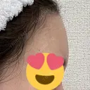 脂肪注入（額） / 脂肪注入（輪郭） 牧野美容クリニック DAY 16 サムネイル用