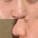 鼻尖形成（切開） / 鼻尖縮小 / その他（鼻） 聖心美容クリニック 札幌院 DAY 20 サムネイル用