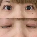 二重切開 松下皮フ形成外科 DAY 25 サムネイル用