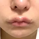 ヒアルロン酸注入（唇） / ボトックス（口角） / ボトックス（肩） ルラ美容クリニック 新宿院 AFTER サムネイル用