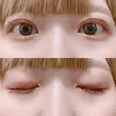 二重切開 松下皮フ形成外科 DAY 27 サムネイル用