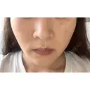 バッカルファット除去 / 脂肪吸引（顔） EMMA CLINIC（エマクリニック） DAY 18 サムネイル用