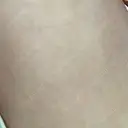 脂肪注入（額） / 脂肪注入（輪郭） 牧野美容クリニック DAY 21 サムネイル用