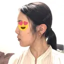 骨切り（あご） / 脂肪吸引（顔） 銀座マイアミ美容外科 DAY 129 サムネイル用