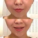 糸リフト / 脂肪吸引（顔） / ボトックス（あご） WOM CLINIC GINZA （ワム クリニック ギンザ） AFTER サムネイル用