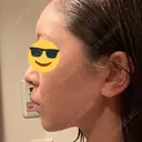 糸リフト / 脂肪吸引（顔） / ボトックス（あご） WOM CLINIC GINZA （ワム クリニック ギンザ） DAY 244 サムネイル用