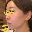 糸リフト / 脂肪吸引（顔） / ボトックス（あご） WOM CLINIC GINZA （ワム クリニック ギンザ） DAY 244 サムネイル用