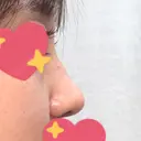 鼻尖形成（切開） / 小鼻縮小（切開） / その他（鼻） / 軟骨移植 グローバルビューティークリニック 東京院 DAY 24 サムネイル用