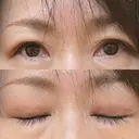 二重切開 / 上まぶたたるみ取り / 上まぶたの脂肪取り 松下皮フ形成外科 AFTER サムネイル用