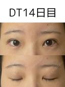二重埋没 けやき美容クリニック 沼津院 DAY 14 サムネイル用