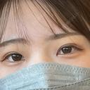 二重埋没 けやき美容クリニック 沼津院 DAY 14 サムネイル用