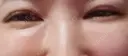 その他（目元） CLASSY 仙台美容外科・美容皮膚科 DAY 14 サムネイル用