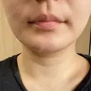 脂肪吸引（顔） THE CLINIC（ザ・クリニック） 福岡院 DAY 31 サムネイル用